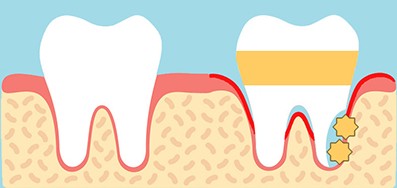 Periodontitis 질환 진행 illustration
